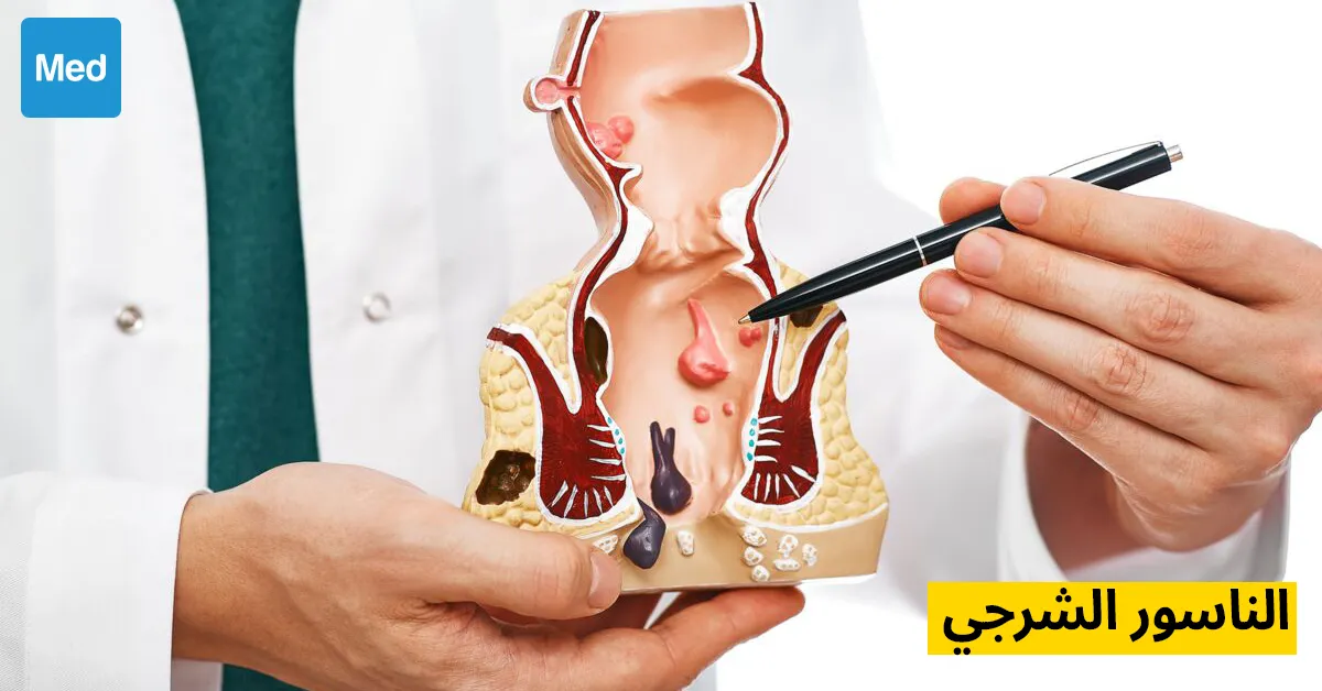 الناسور الشرجي: فهم هذا المرض المؤلم